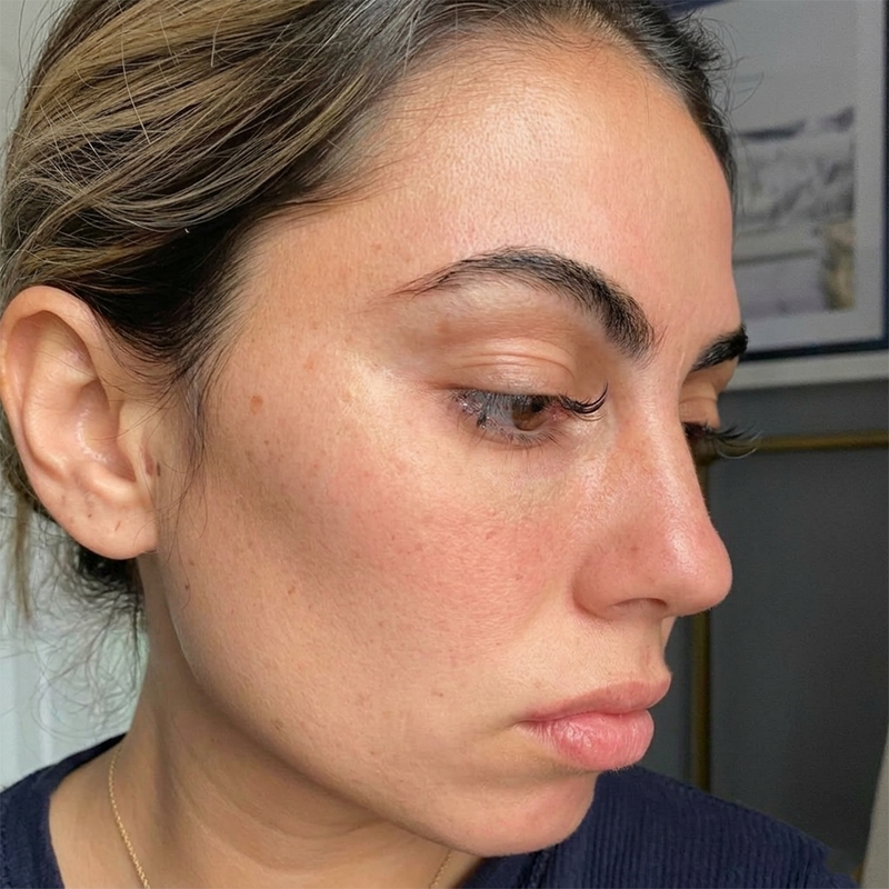 IMPROVE YOUR SKIN TEXTURE & REDUCE WRINKLES